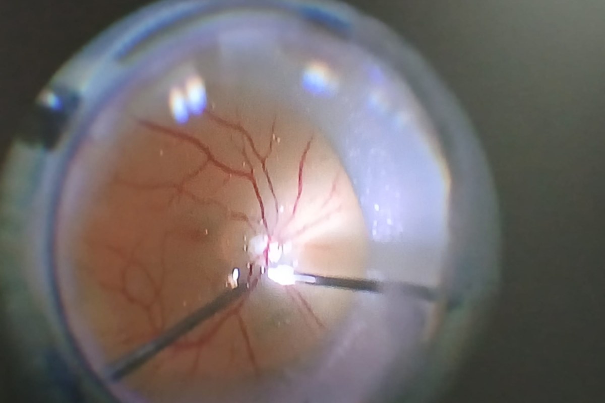 A view through the operating microscope during model-eye practice, where instrument control and tissue handling are refined.